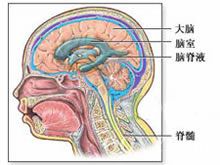 先天性腦積水