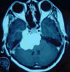 繼發性顱內腫瘤