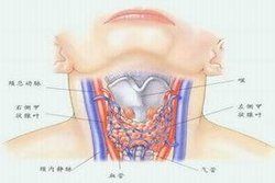 急性甲狀腺炎