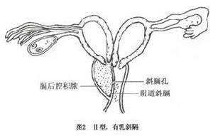 陰道斜隔