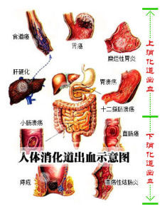 上消化道大量出血