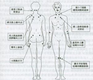 纖維肌痛綜合症