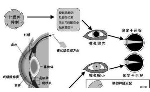 調節痙攣