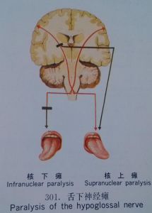 舌下神經損傷