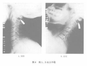 （圖）上頸椎不穩症