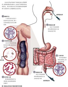 腸胃生態平衡的破壞和恢復
