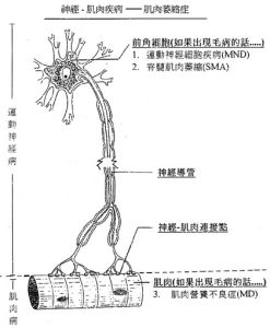 脊髓性肌萎縮症