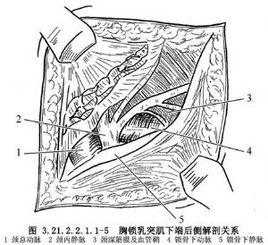 胸鎖乳突肌下端切斷術