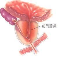 細菌性前列腺炎