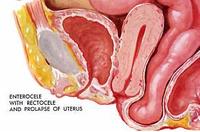 （圖）陰道後壁脫垂