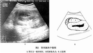 腹膜後膿腫