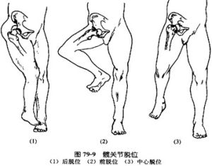 髖關節後脫位