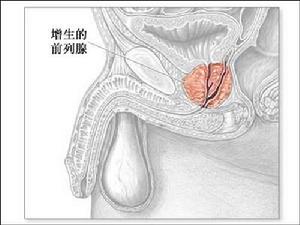 前列腺增大