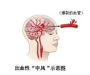 出血性腦中風