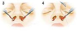 一種鼻部手術過程