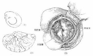 膠質母細胞瘤