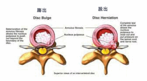 腰椎間盤膨出