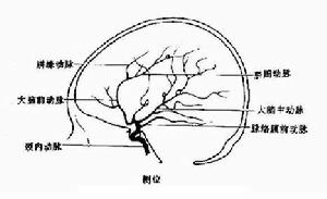 外傷後頸內動脈閉塞