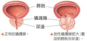 前列腺肥大