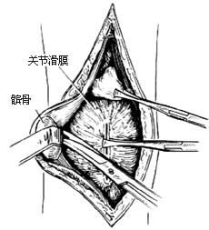 先天性外展性髖攣縮