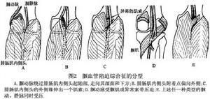 膕血管陷迫綜合徵