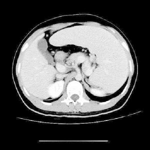 肝硬化性腎損害