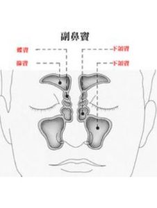 雙側篩竇炎