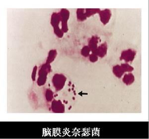 化膿性腦炎病毒