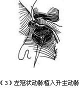 （圖）冠狀動脈異位起源