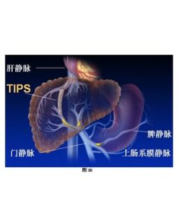 門靜脈高壓性胃病