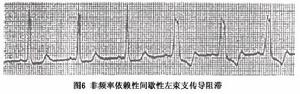 左束支傳導阻滯