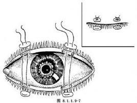 瞼緣縫合術