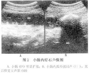 腸石性腸梗阻