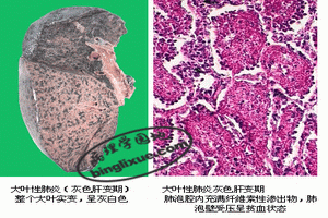 葡萄球菌肺炎