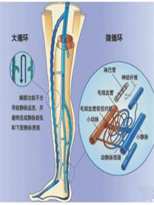 深靜脈血栓