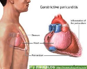 慢性縮窄性心包炎
