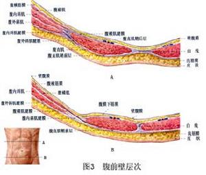 白線疝 圖3