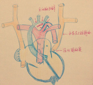 主動脈弓縮窄