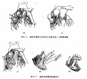 （圖）手術治療（圖一）