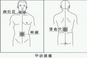 胸內甲狀腺腫