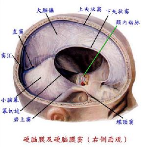 慢性硬腦膜外血腫