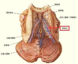 脈絡叢乳頭狀瘤