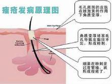 痤瘡生成機制