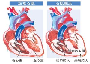 心臟肥大