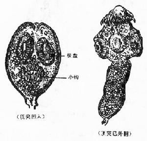 腦棘球蚴病