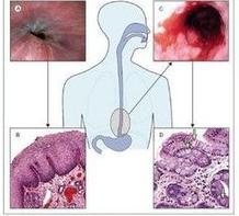 Barrett食管炎