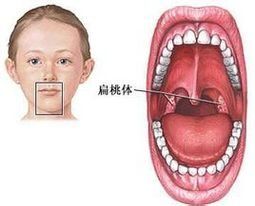 兒童扁桃體炎