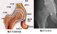 高雪氏症