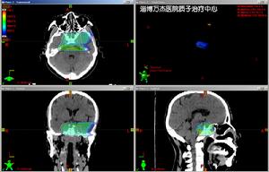 （圖）質子治療計畫