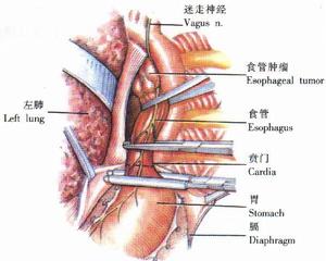 胸導管損傷